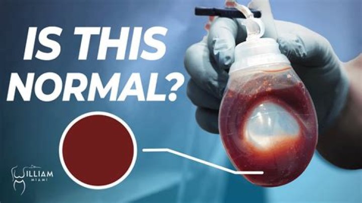 Is Sanguineous drainage normal
