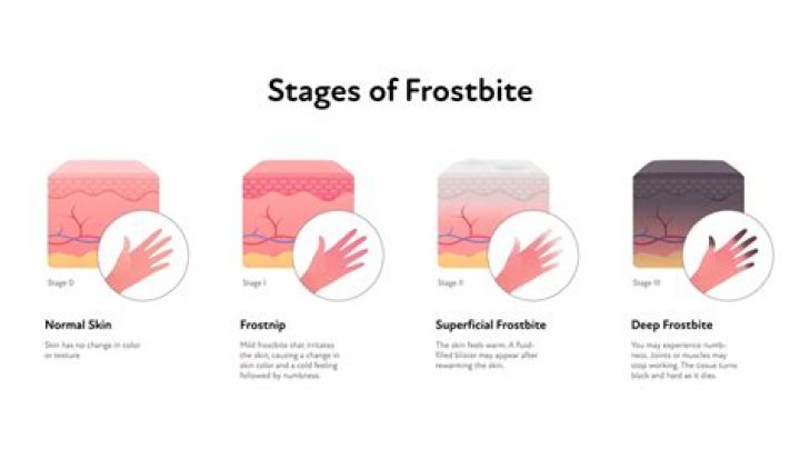Is second-degree frostbite bad