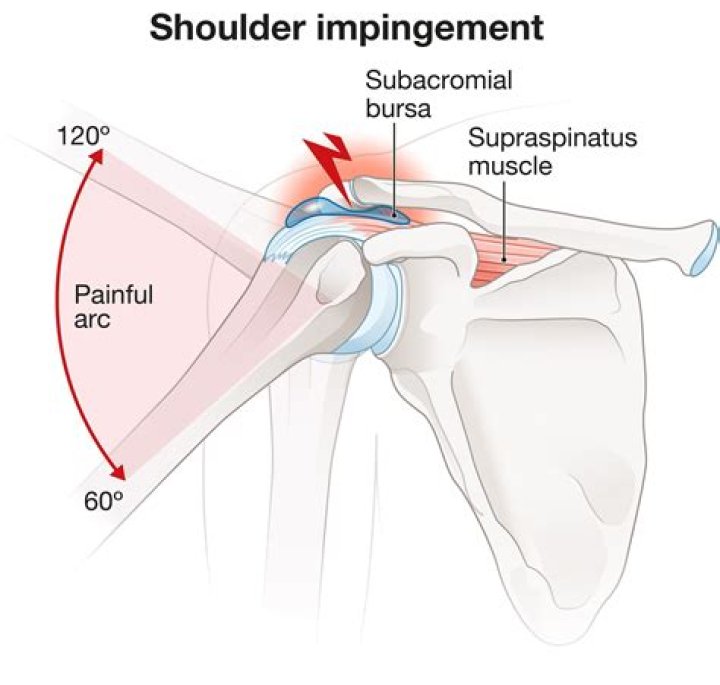 Is shoulder impingement common