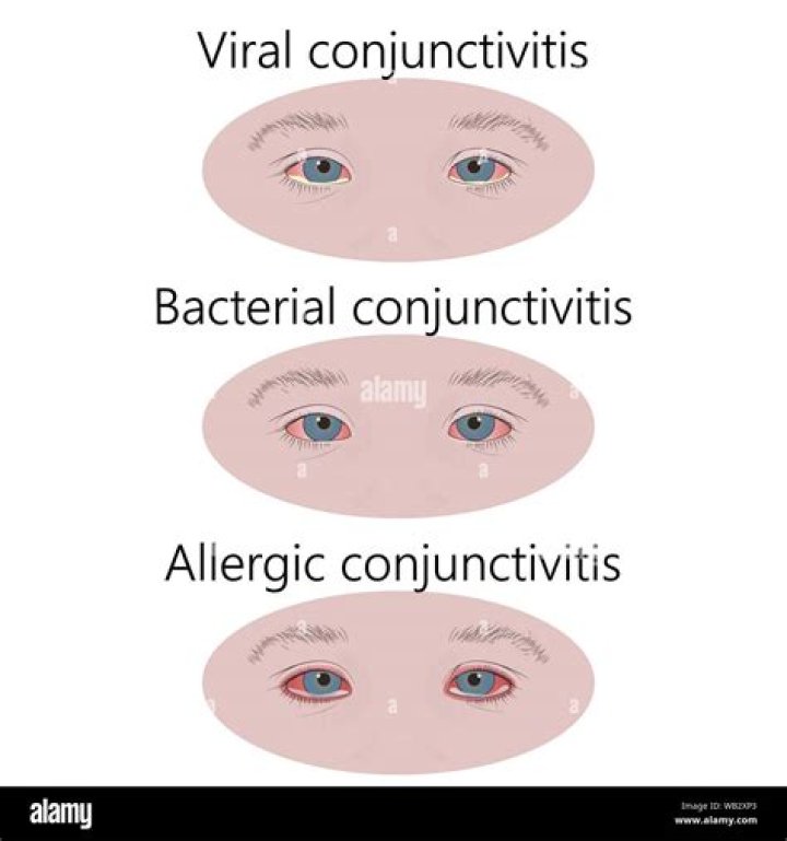 Is viral conjunctivitis bilateral
