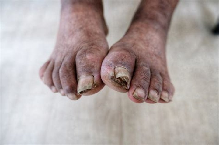 ¿Qué es la gangrena