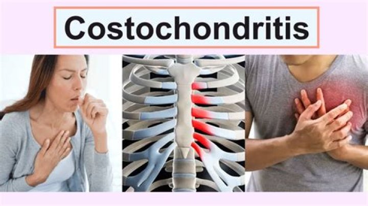 ¿Qué produce la costocondritis