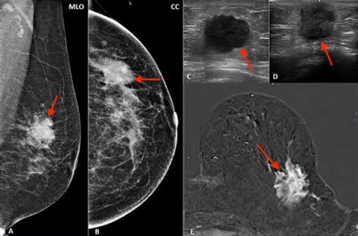 What are abnormal breast cells
