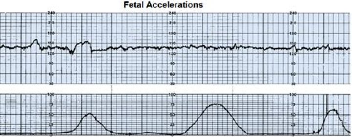 What are accelerations in pregnancy