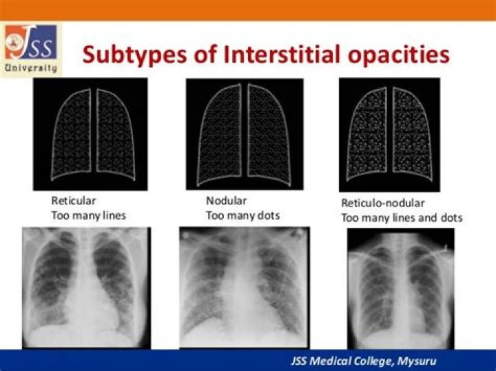 What are interstitial opacities