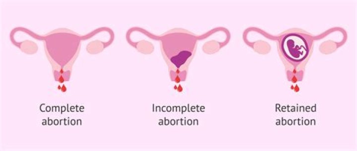 What are the types of abortion