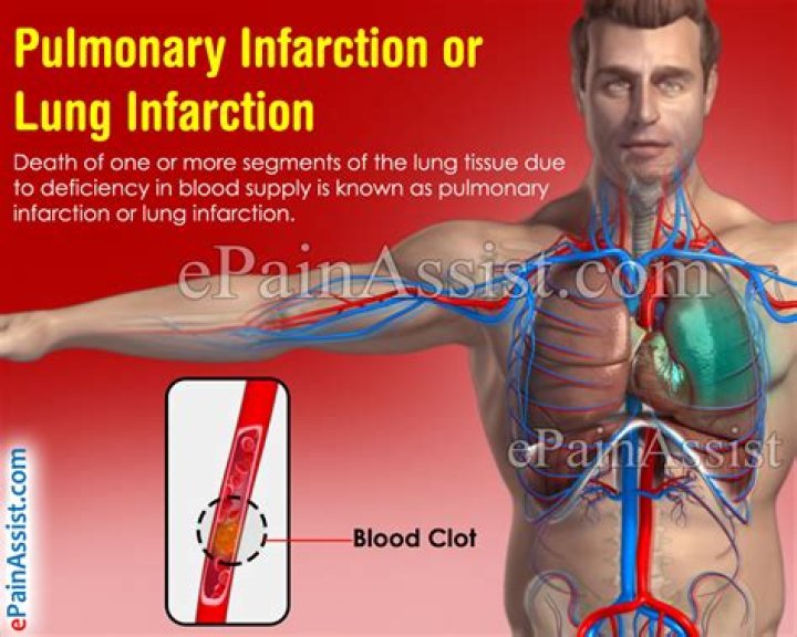 What causes a lung infarction