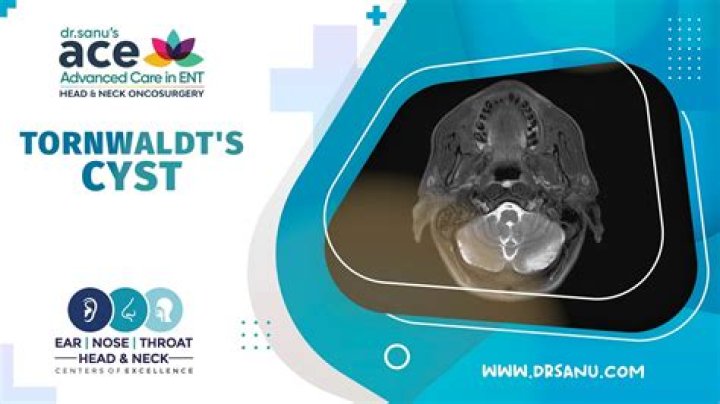 What causes a Thornwaldt cyst