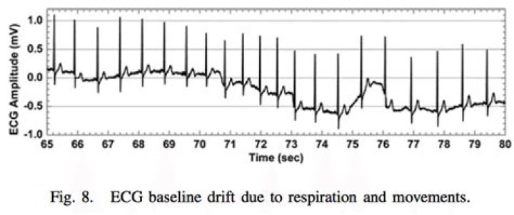 What causes baseline drift in ECG