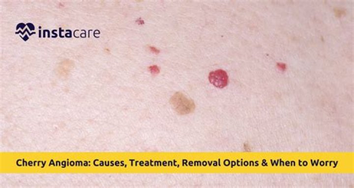 What causes cherry hemangiomas