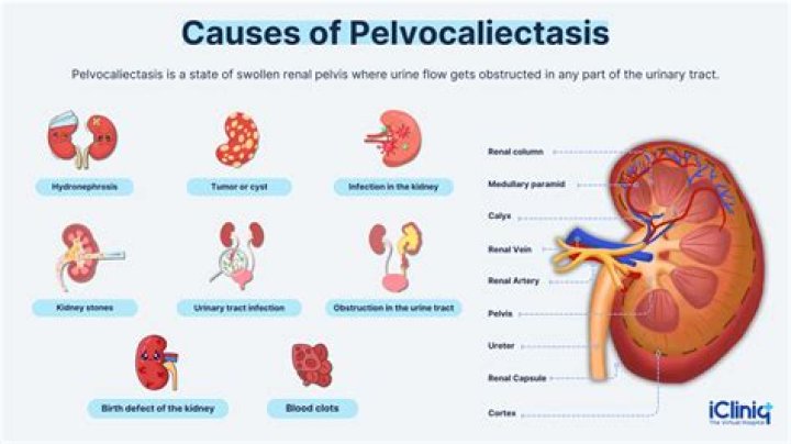 What causes mild Pelviectasis