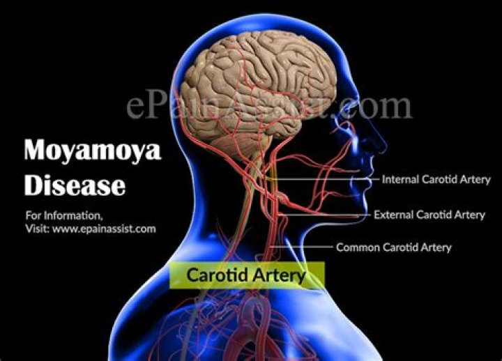 What causes Moyamoya in adults