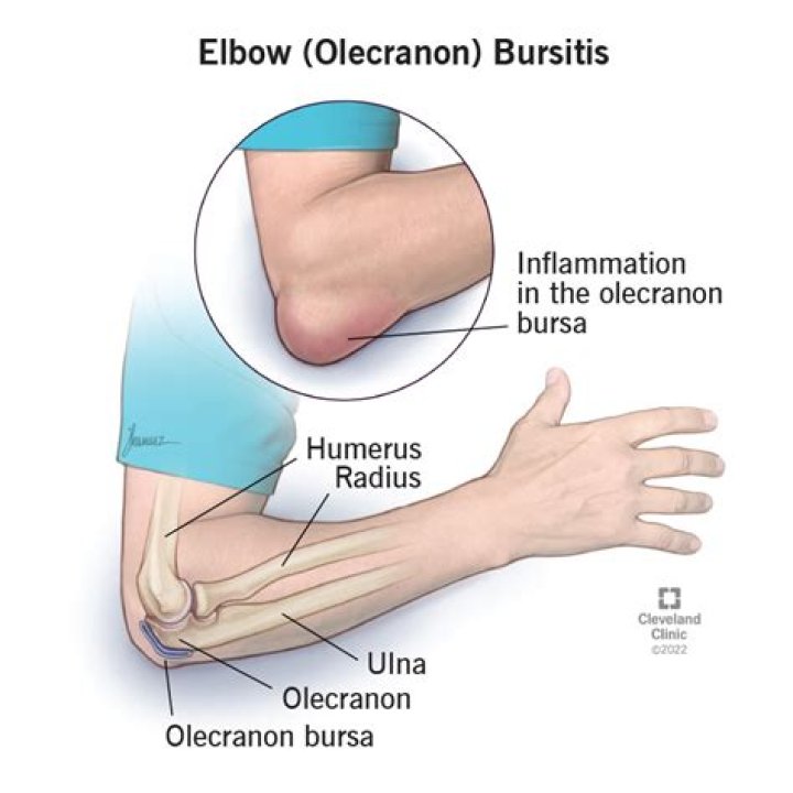 What causes olecranon bursitis