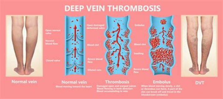 What causes pelvic thrombosis