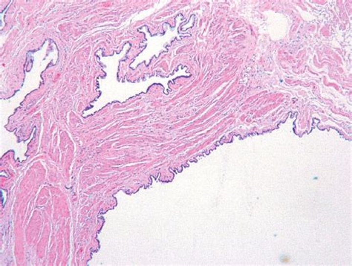 What causes Periurethral cyst