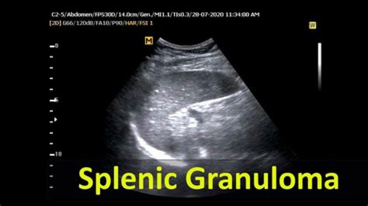 What causes splenic granulomas