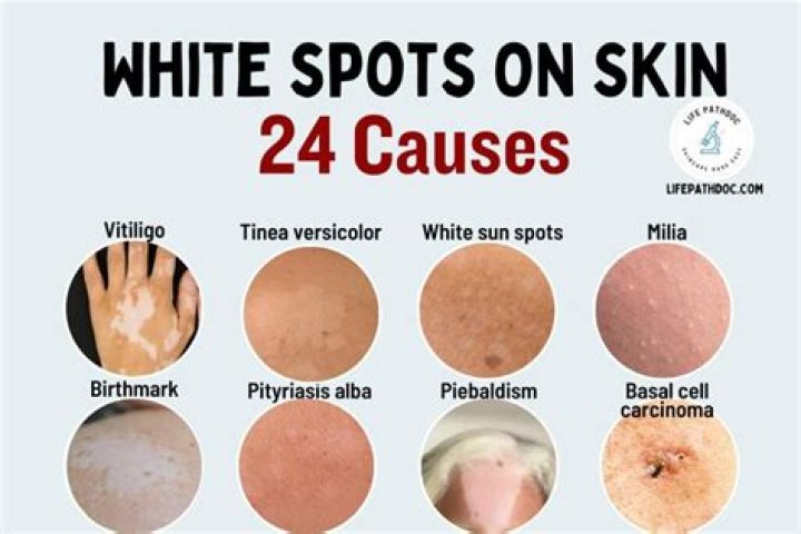 What causes white spot lesions