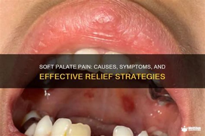 What depresses the soft palate