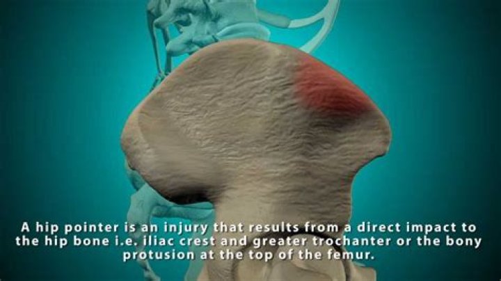 What does a hip pointer feel like