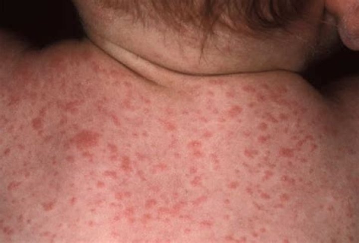 What does typhoid rash look like