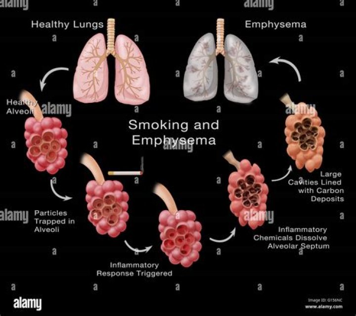 What happens to DLCO in emphysema