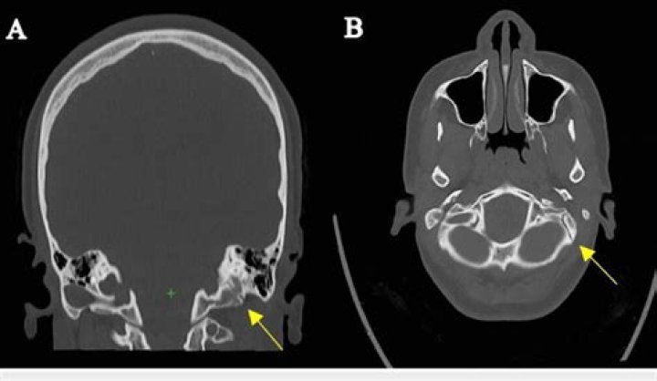 What is a CT petrous bones scan for