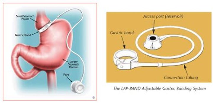 What is a lap band adjustment