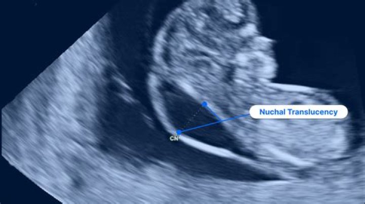 What is a NT scan at 13 weeks
