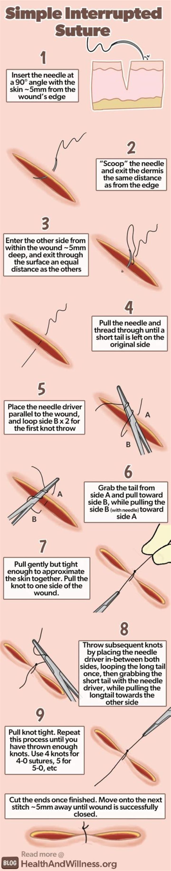 What is a simple wound repair