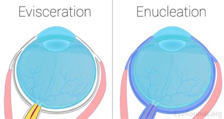 What is enucleation of a Mass