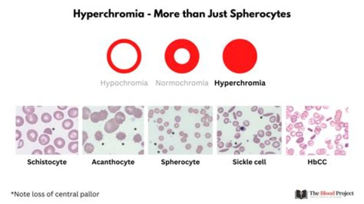 What is Hyperchromic