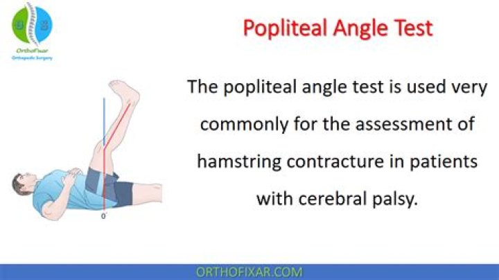 What is normal popliteal angle