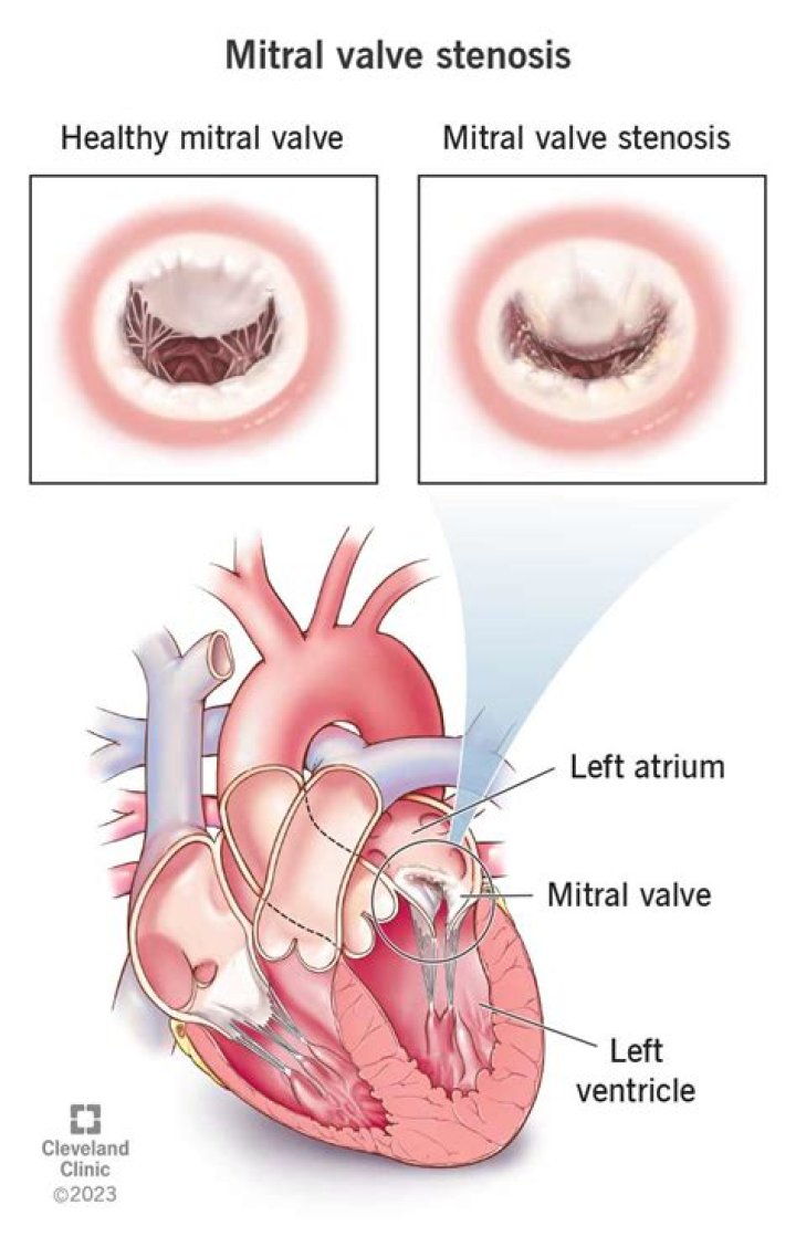 What is open mitral Valvotomy