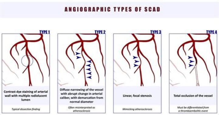What is SCAD abbreviation for