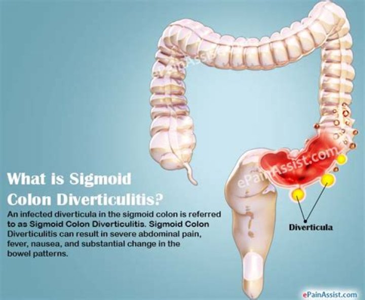 What is sigmoid diverticulosis