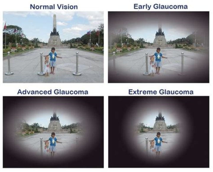 What is vision like with glaucoma