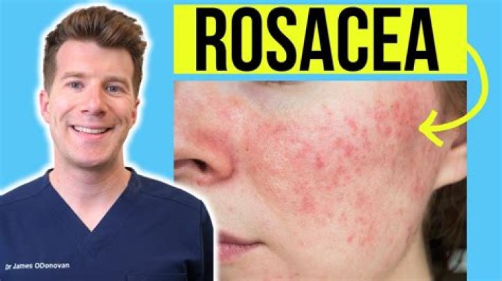 What products are bad for rosacea