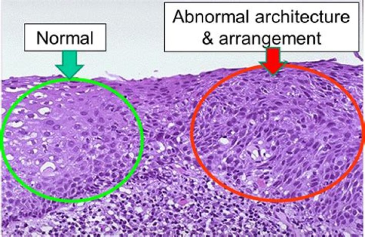 What stage of cancer is dysplasia