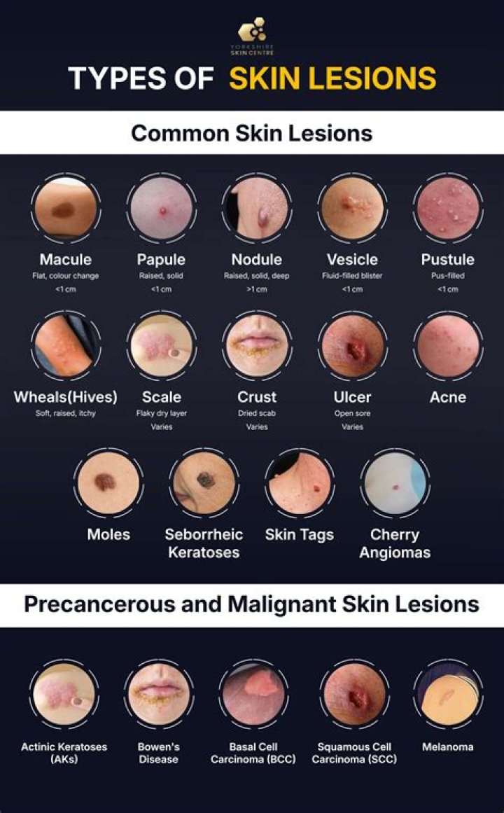 What type of lesion is a blister